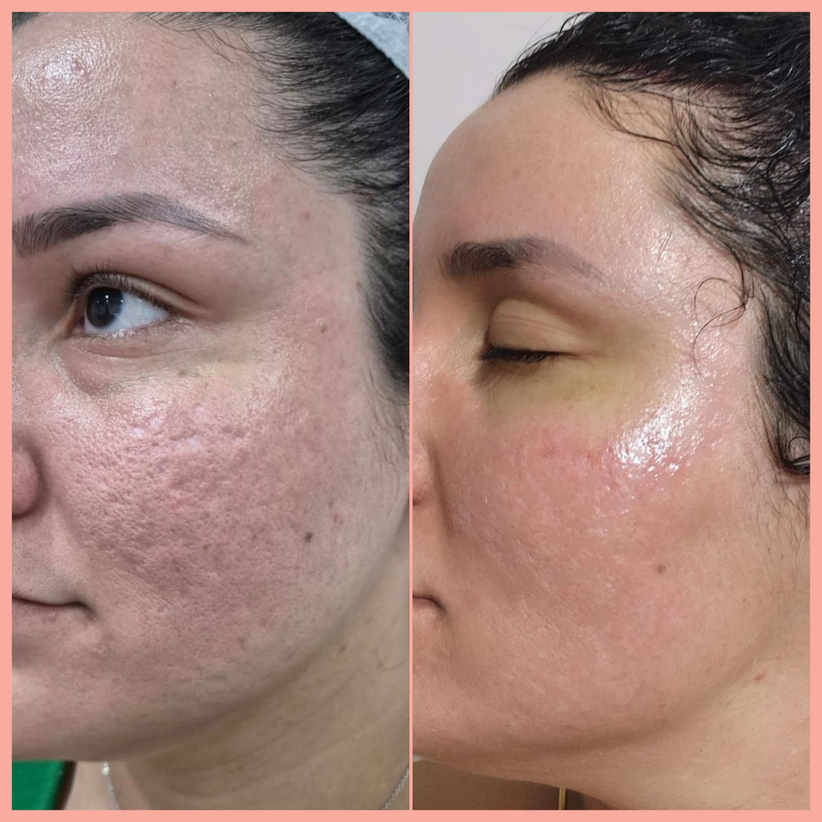 Jato de Plasma — antes e depois