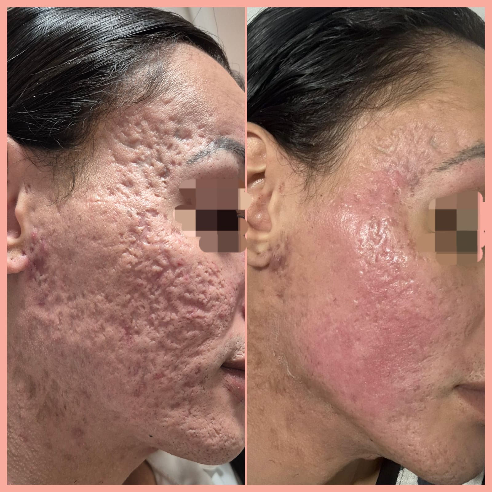 Rennova Skin — antes e depois