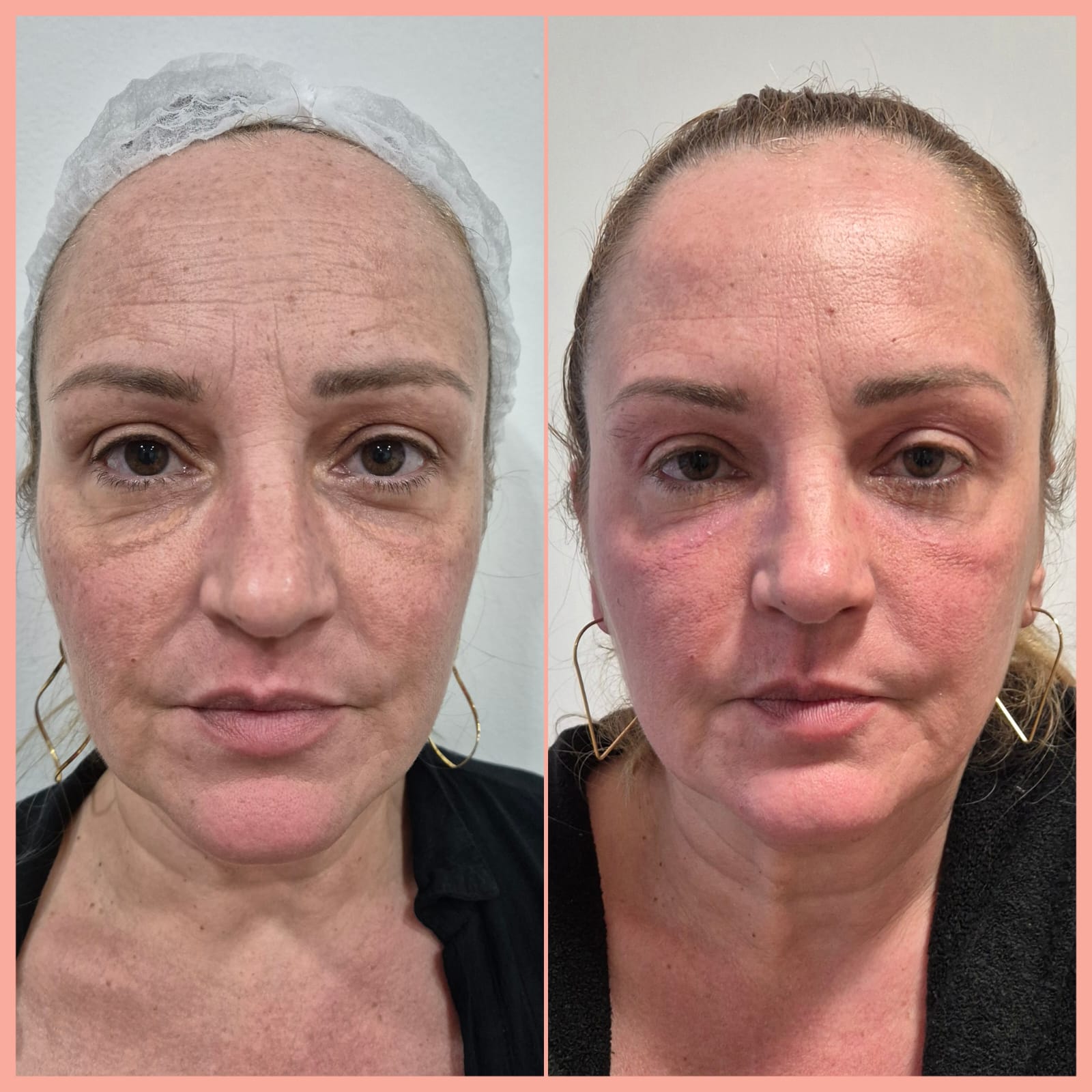 Jato de Plasma — antes e depois