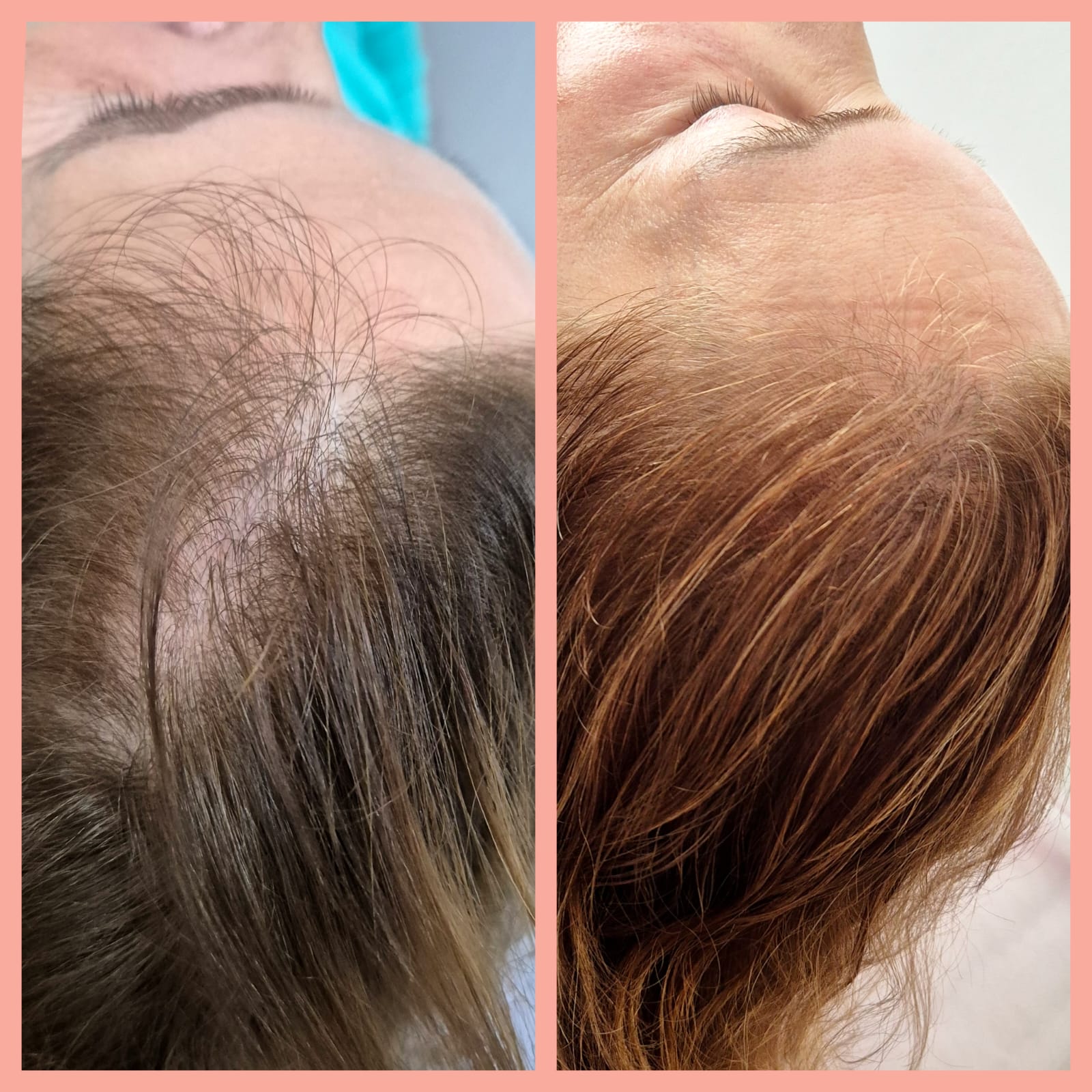 Terapia Capilar — antes e depois