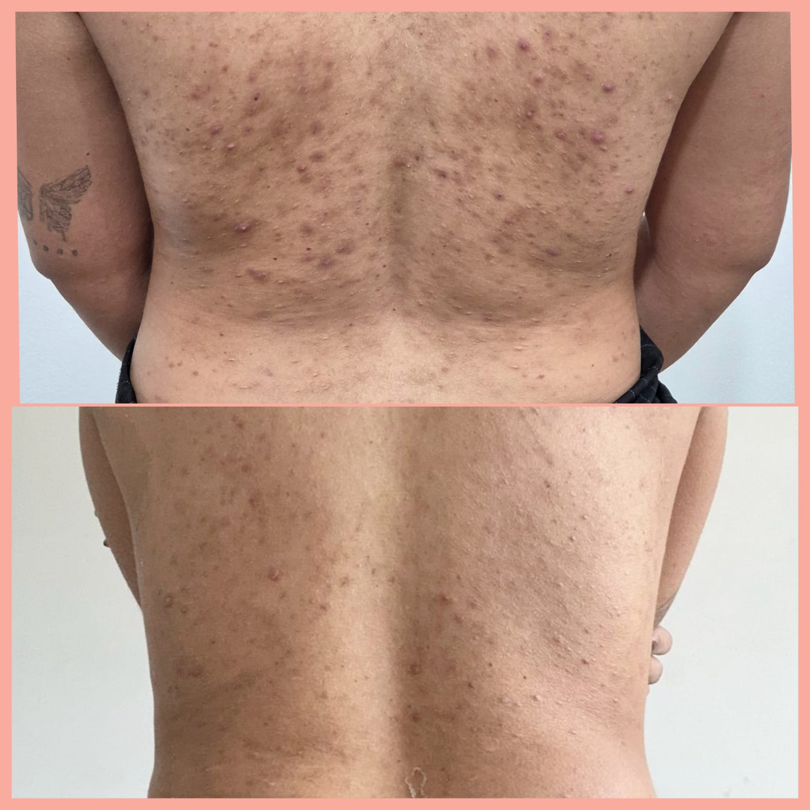 Peeling Biológico — antes e depois