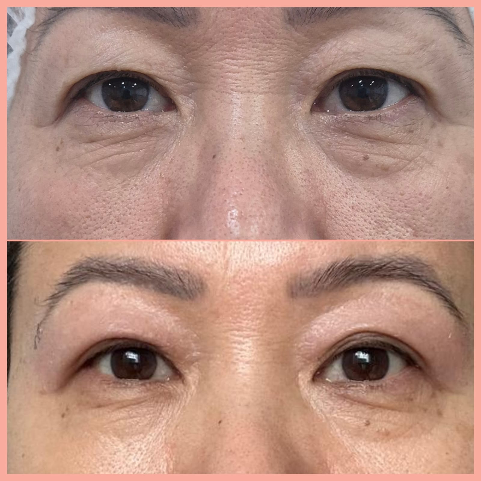 Jato de Plasma — antes e depois