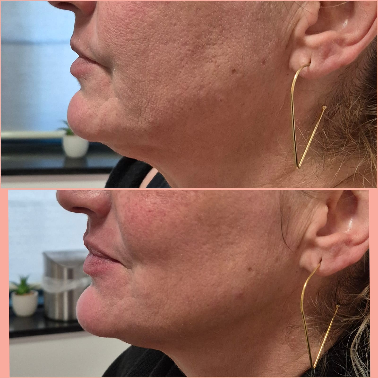 Ultrassom Microfocado — antes e depois